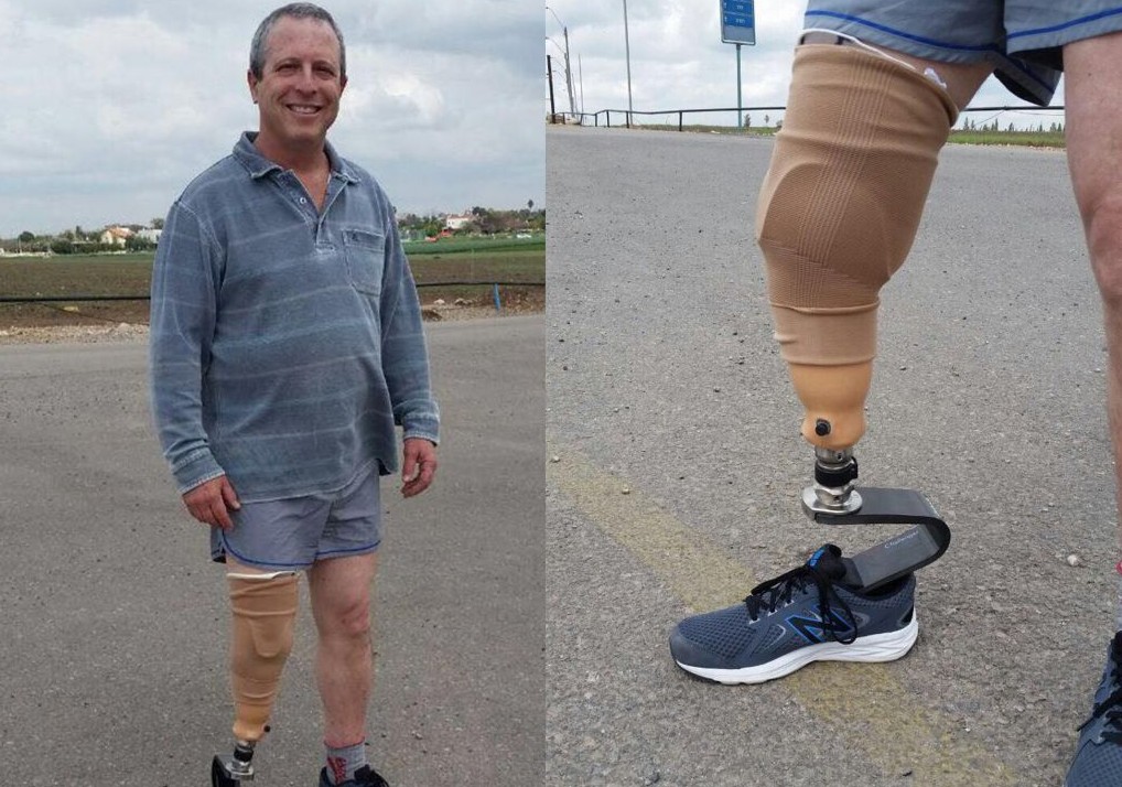 Yair with his new leg 