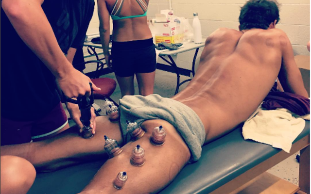 Michael Phelps receiving a cupping treatment. (Screenshot from Instagram)
