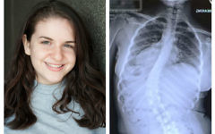 Lucy-Mae, and the x-ray showing her spine curvature Lucy-Mae, and the x-ray showing her spine curvature