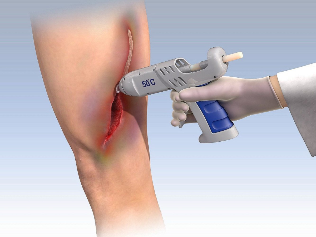 Researchers at Technion think they may have found a work-around a painful combination of pins and stitches