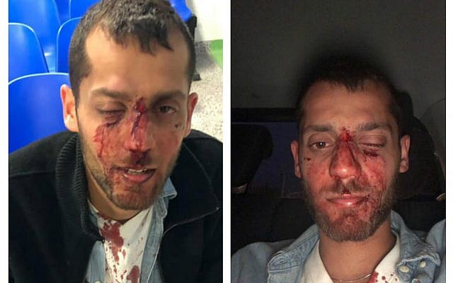 Bloodies Yotam Kashpizky after the attack (Facebook/Barak Kashpizky)