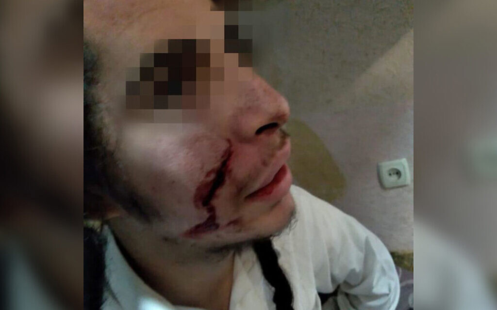 A Jewish teenager was lightly wounded in a suspected knifing attack in Uman, Ukraine on Oct. 1`7, 2020. (Courtesy of the United Jewish Community of Ukraine via JTA)