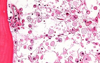 Micrograph showing crinkled paper macrophages in the marrow space in a case of Gaucher disease. Credit: Wikipedia.