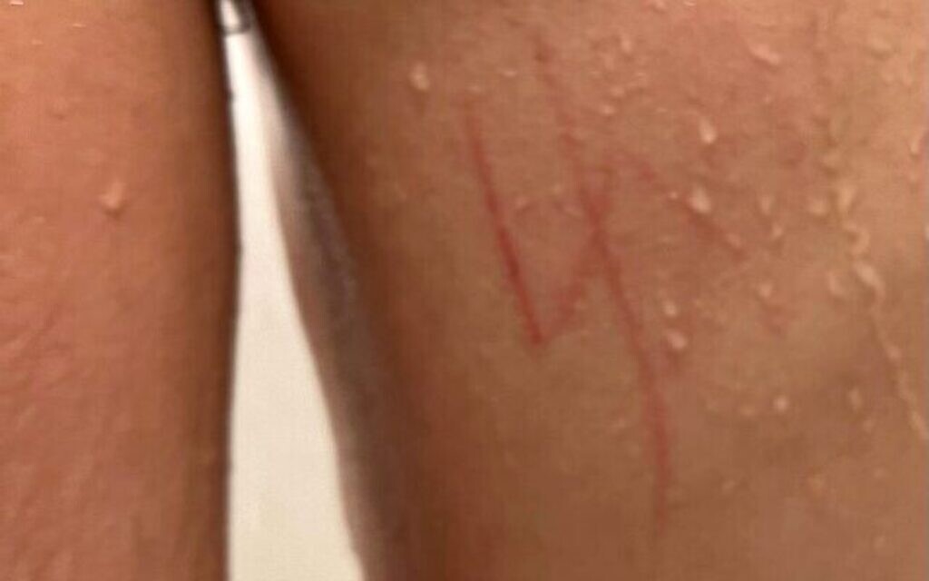 A 17-year-old autistic Jewish student had a swastika carved onto his back after returning from his school in Las Vegas last month. 
