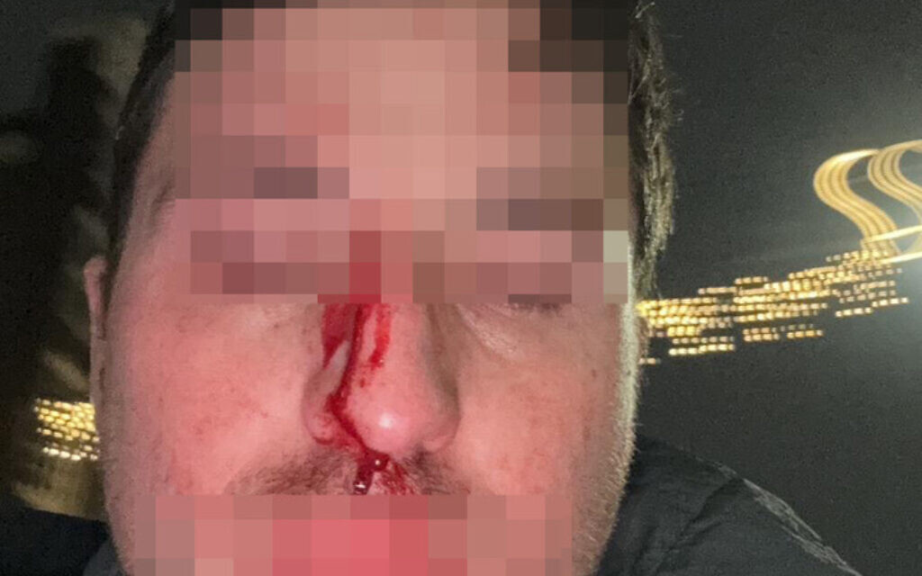 Aaron from Hendon, attacked in Amsterdam. He required emergency stitches at a local hospital