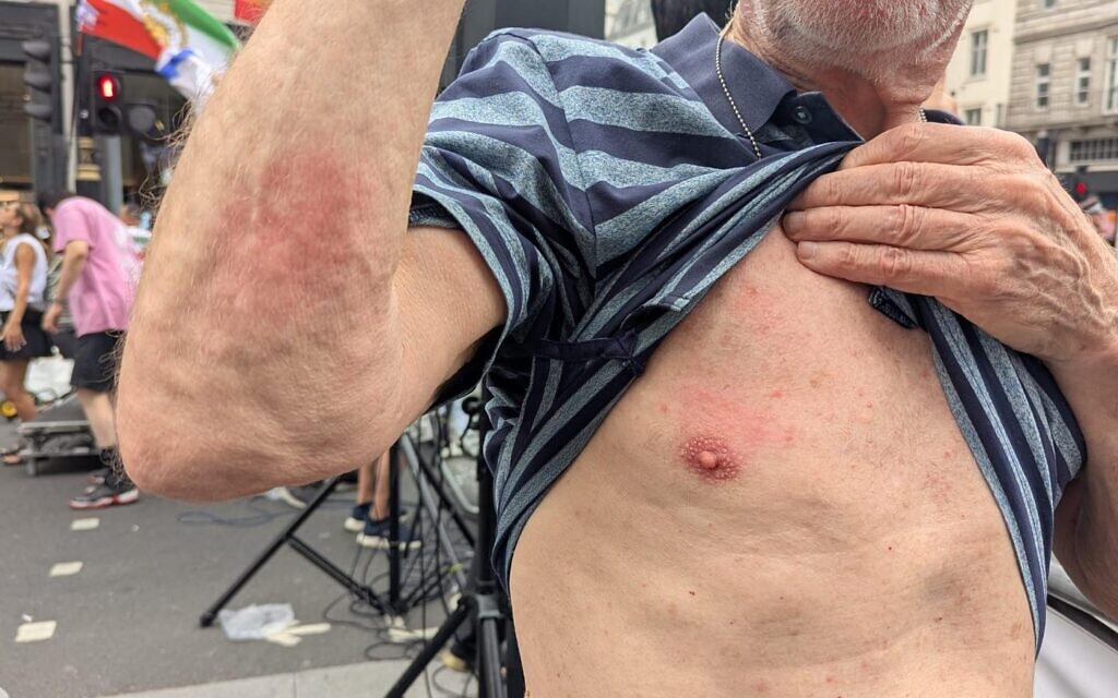 Martin shows bruising on his chest and arm after being struck by a glass bottle at Saturday’s protest.