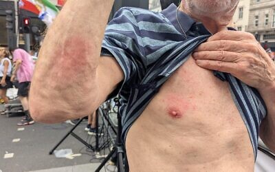 Martin shows bruising on his chest and arm after being struck by a glass bottle at Saturday’s protest.