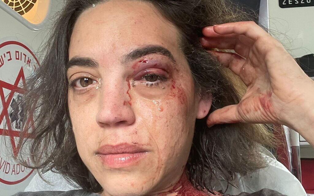 Michal, an Israeli activist and producer of We Will Dance Again, photographed in an ambulance after being injured in a rocket strike. Courtesy of Michal