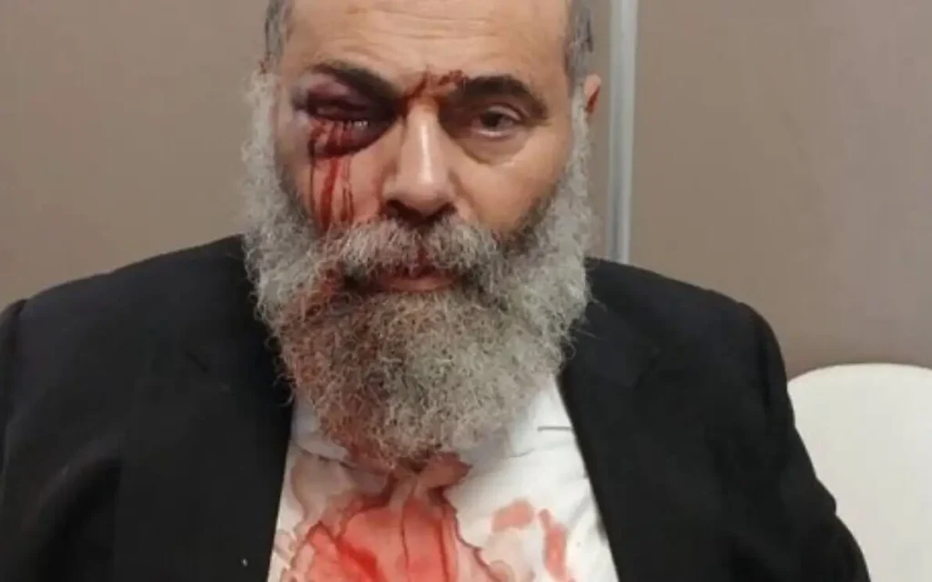 Gilles Cohen, 67, was left bloodied after being attacked and called a “dirty Jew” in Paris. (Photo: Cohen family)