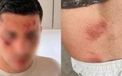 Israeli visitor shows bruising to his face and back following the alleged antisemitic attack in Golders Green. Israeli visitor shows bruising to his face and back following the alleged antisemitic attack in Golders Green.