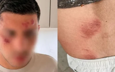 Israeli visitor shows bruising to his face and back following the alleged antisemitic attack in Golders Green.